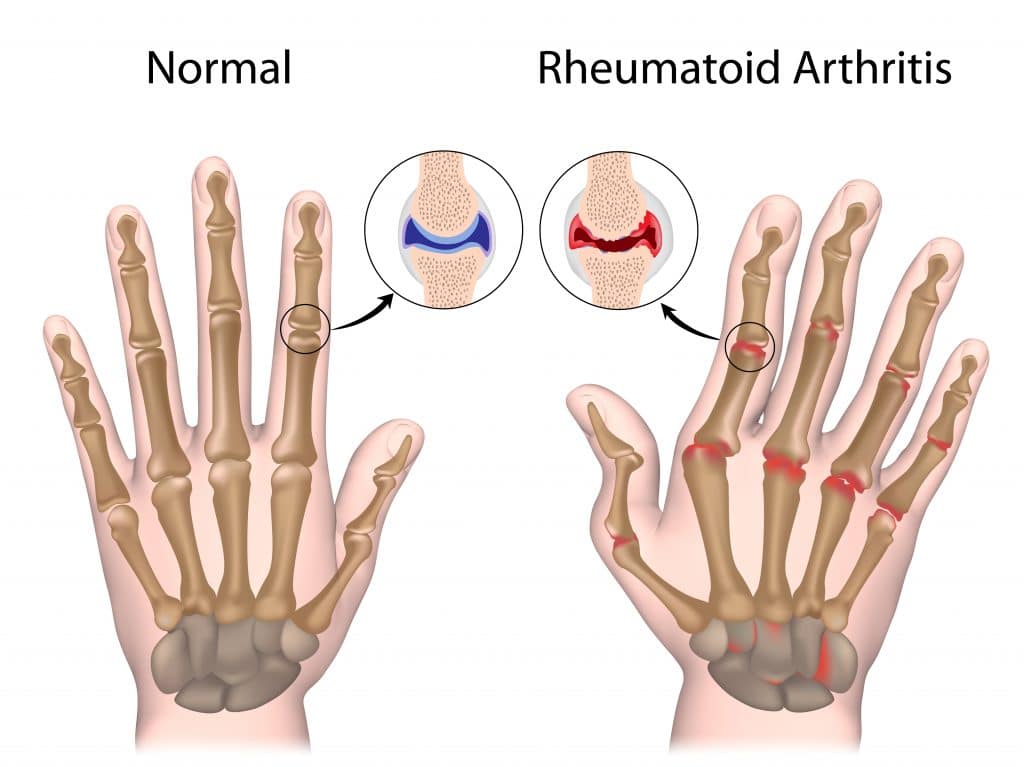 Rheumatoid Arthritis Causes