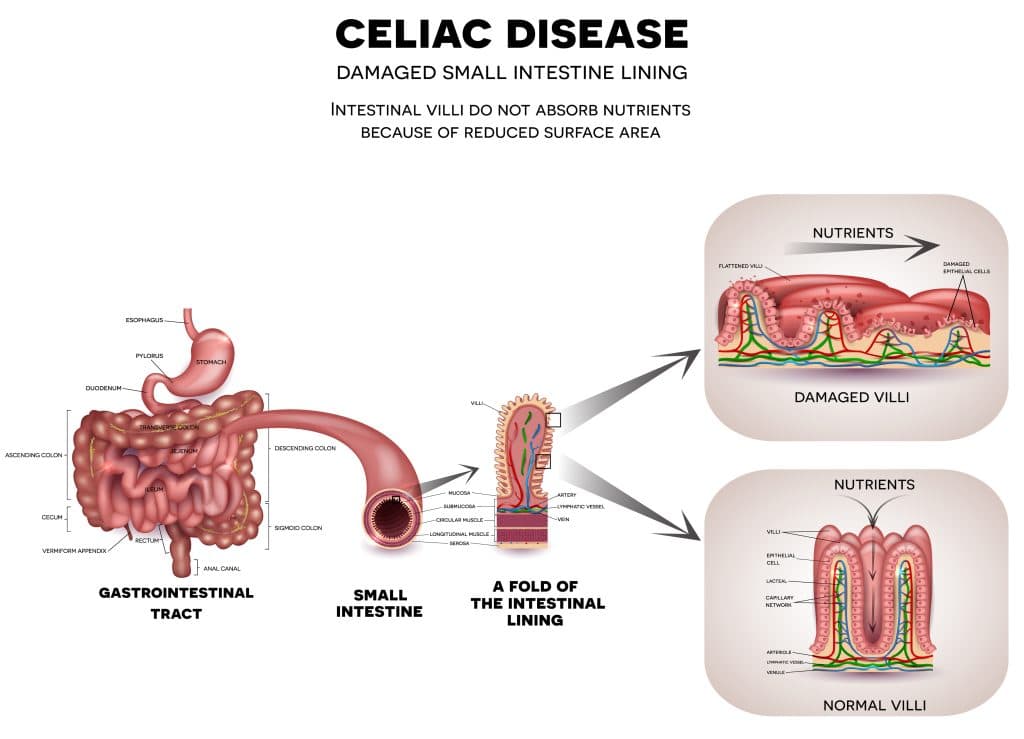 Glyphosate And Disease - Celiac Disease