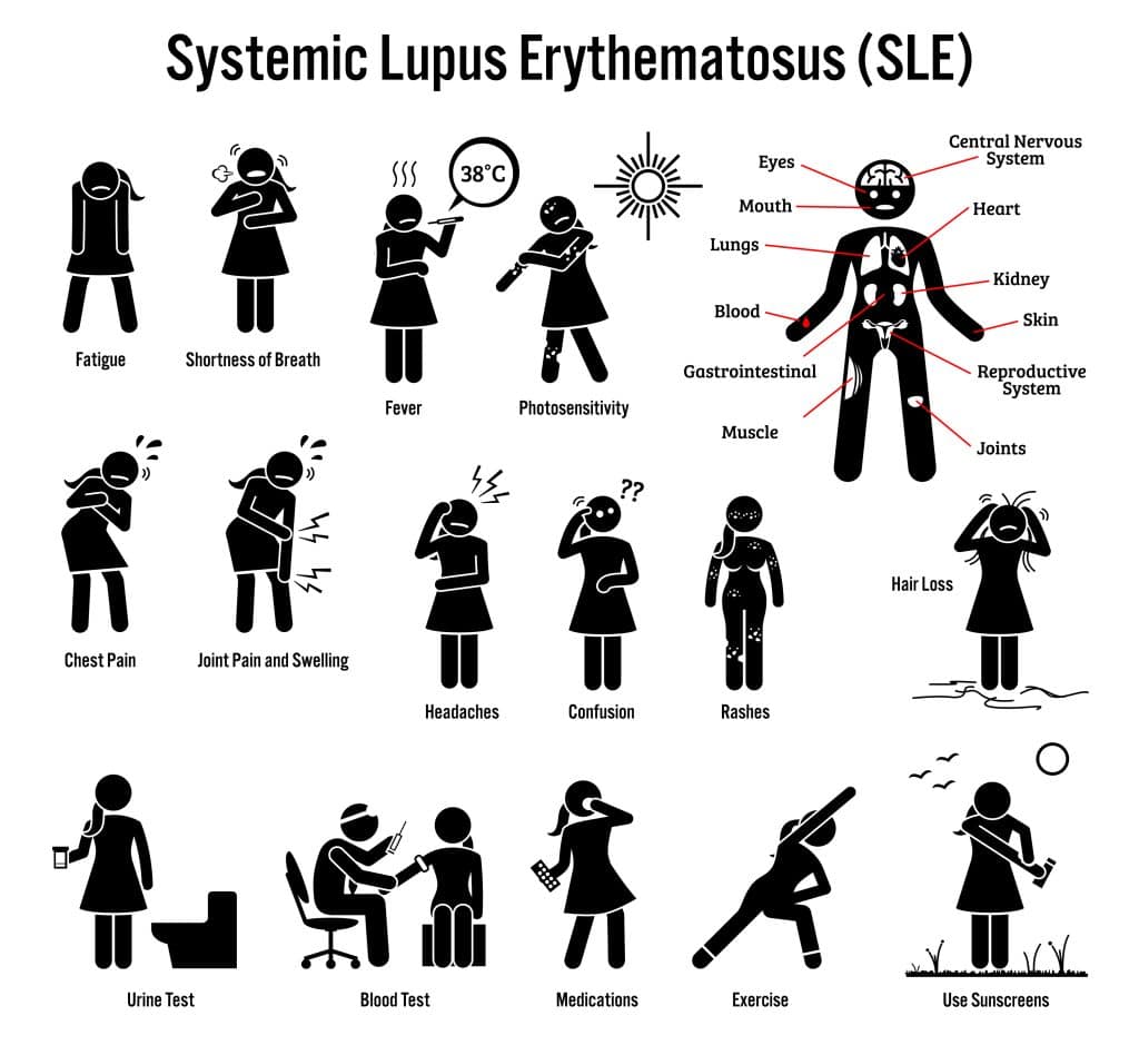 Systemic lupus erythematosus (SLE) symptoms