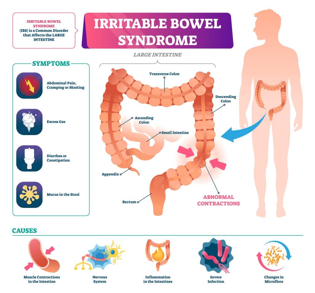IBS causes and symptoms