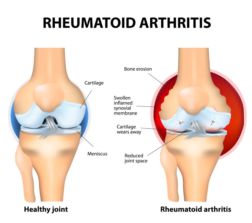 Vitamin D And Rheumatoid Arthritis (RA)