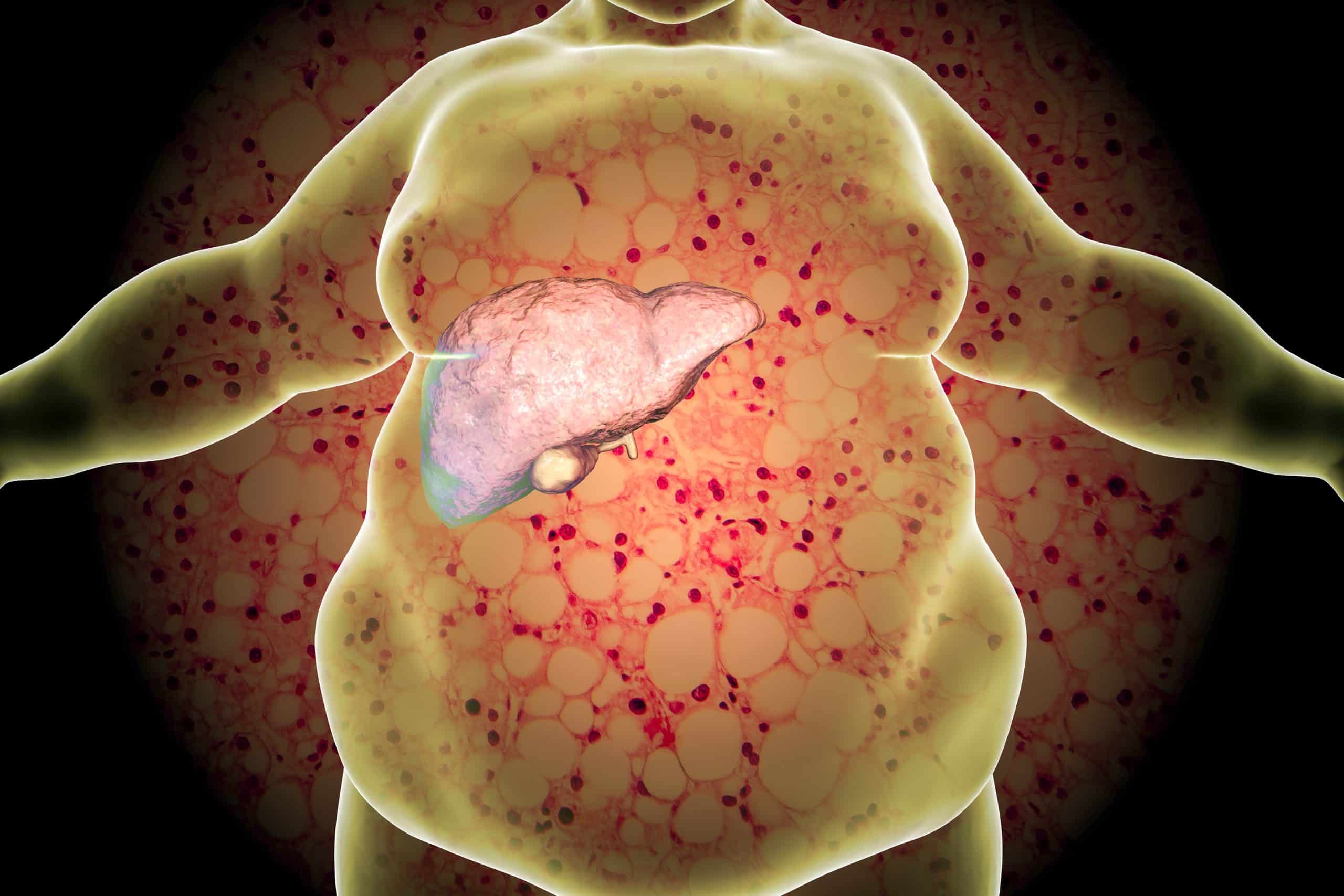 What Causes Fatty Liver Disease