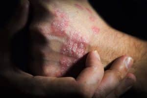 What Causes Psoriasis