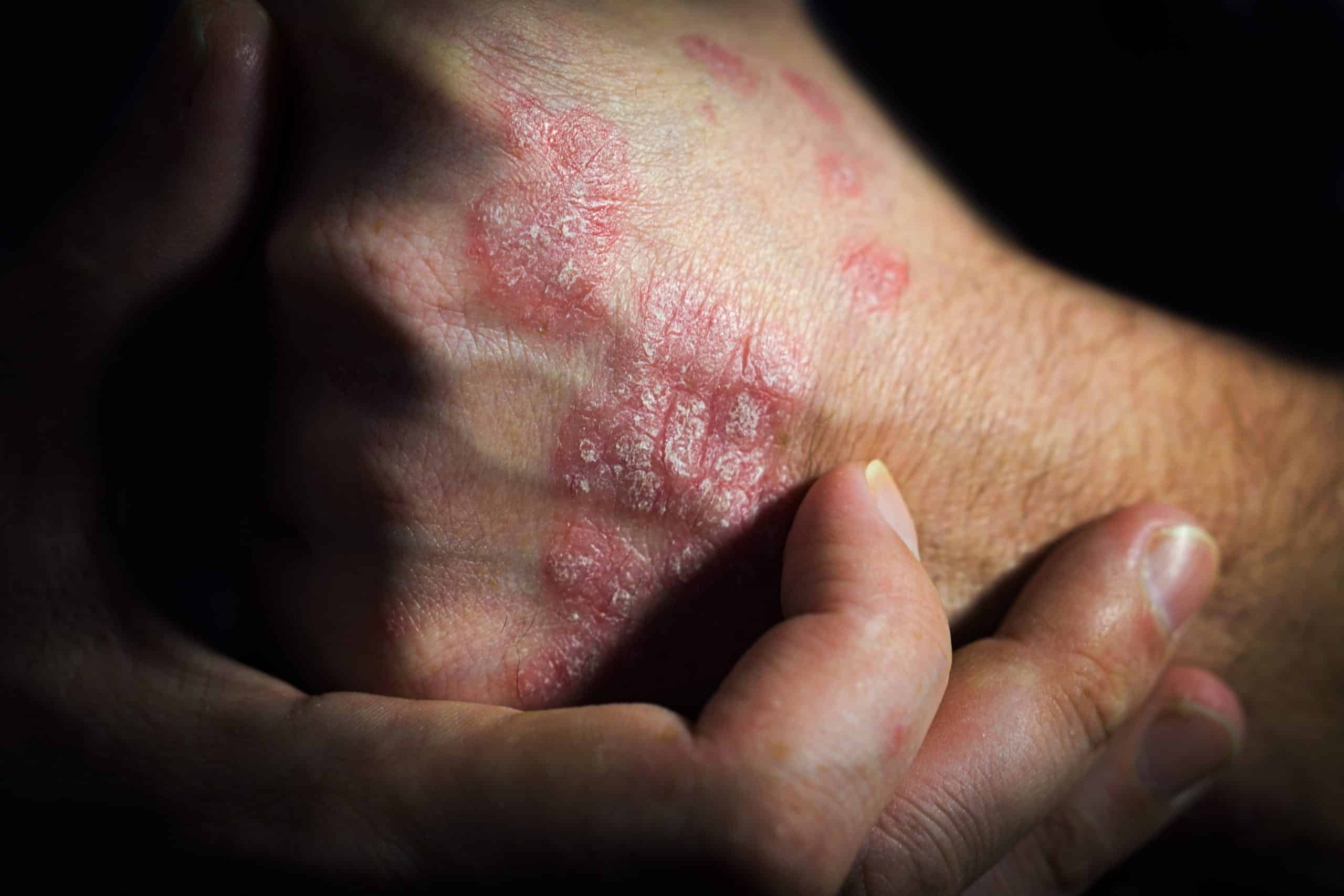 What Causes Psoriasis