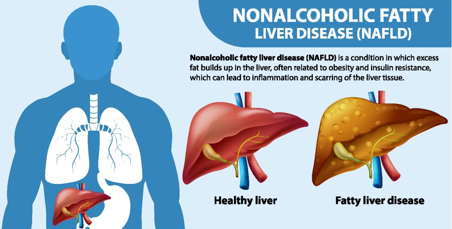 WHAT CAUSES FATTY LIVER DISEASE IN ADULTS visual data 5