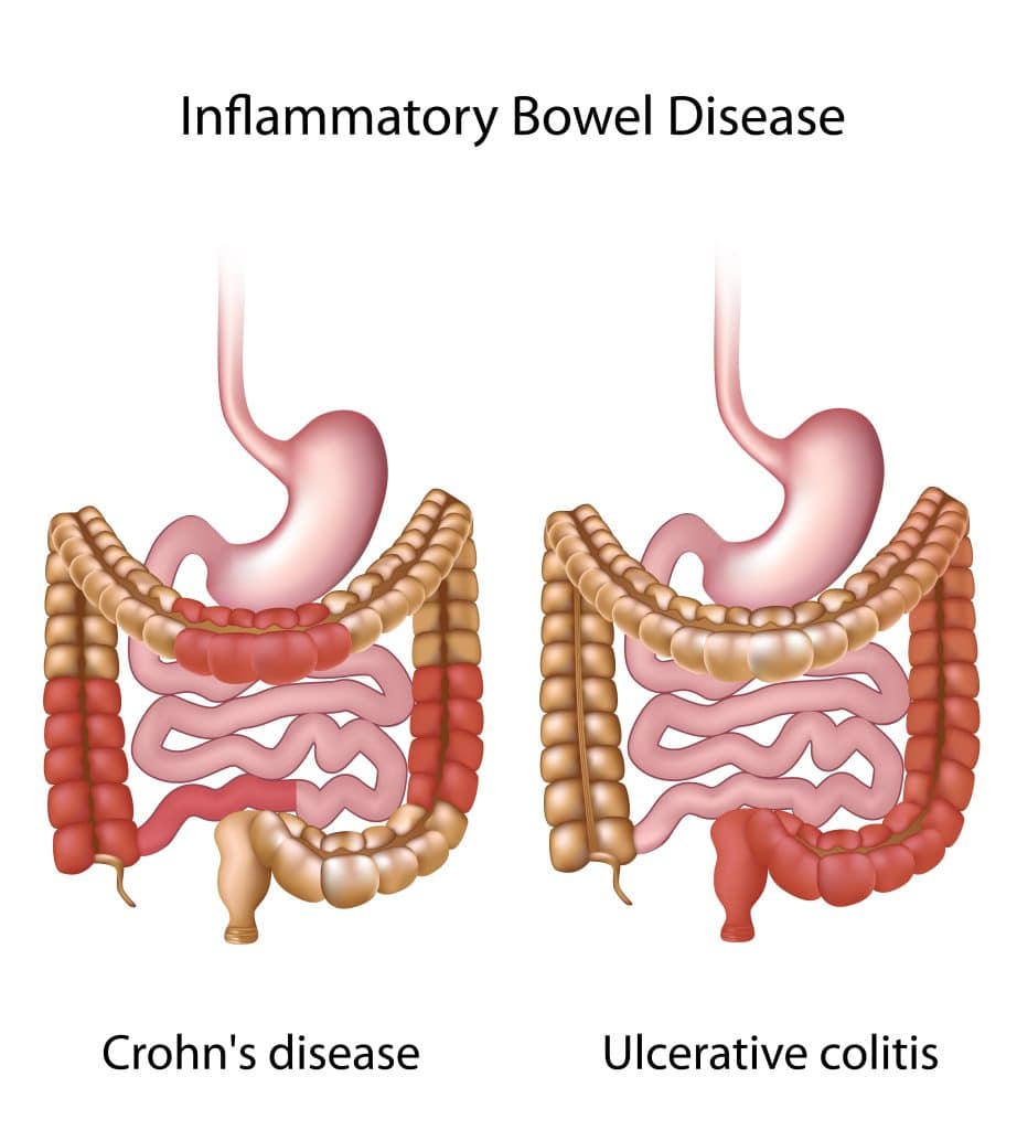 What Causes Inflammatory Bowel Disease