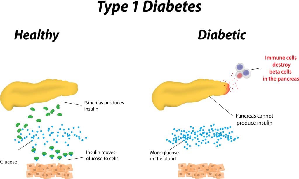 What Causes Type 1 Diabetes