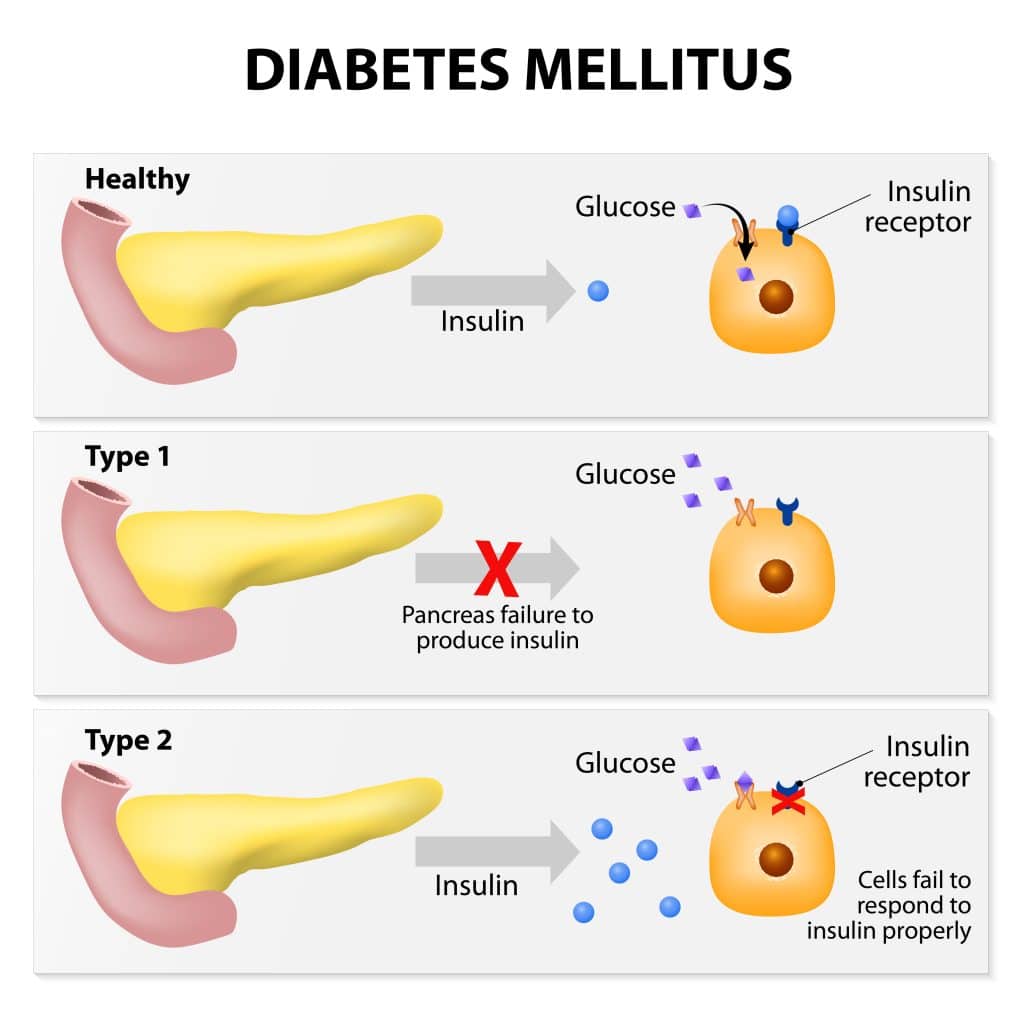 Type 1 and type 2 Diabetes 
