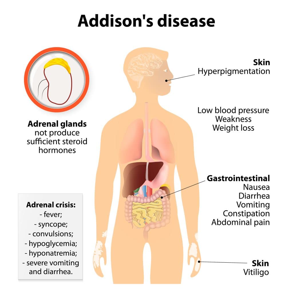 Treating Addison’s Disease