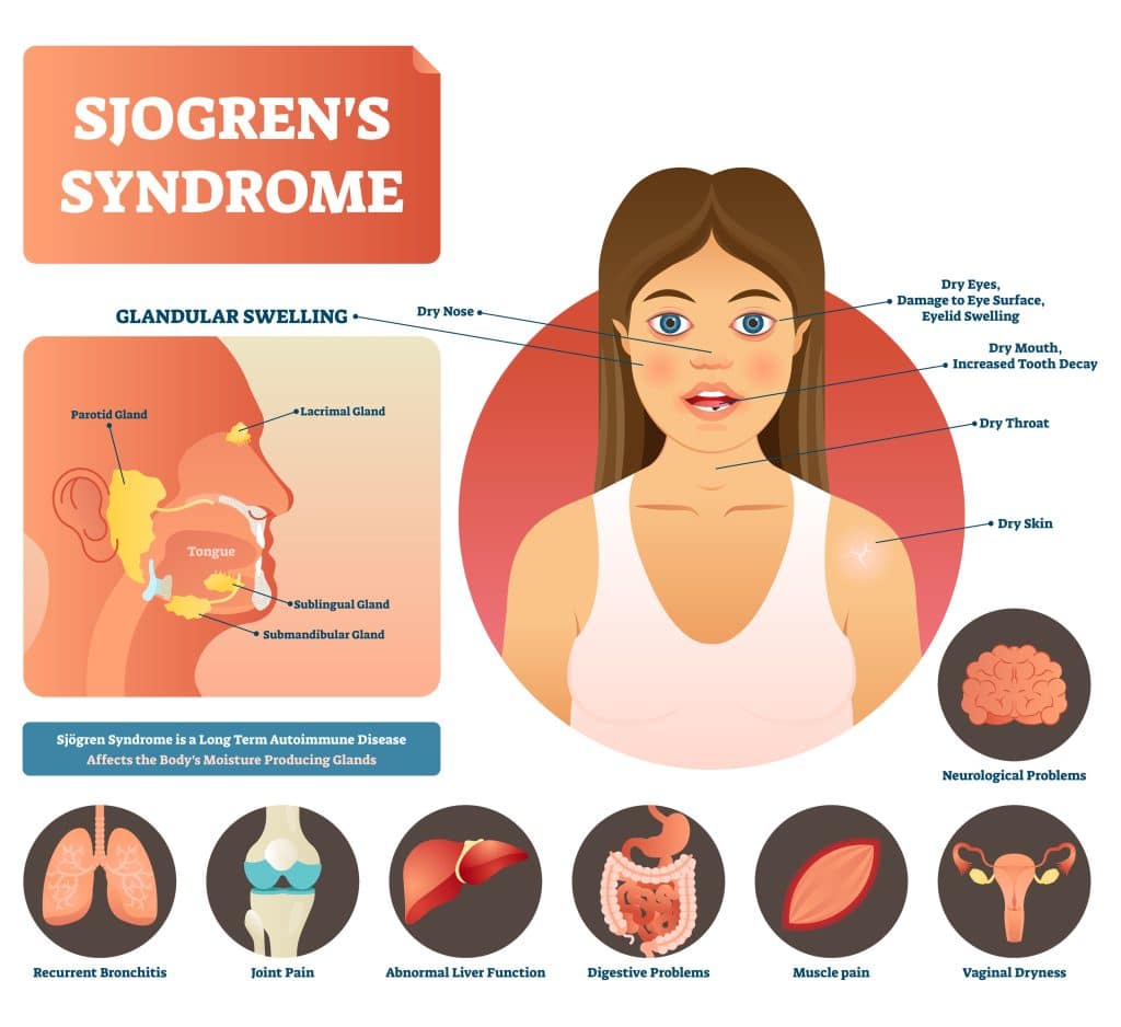 What Causes Sjögren’s Syndrome