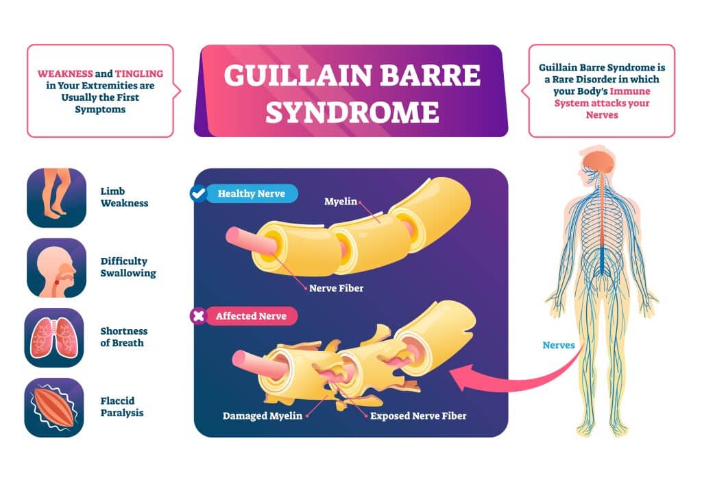 What Causes Guillain-Barre Syndrome