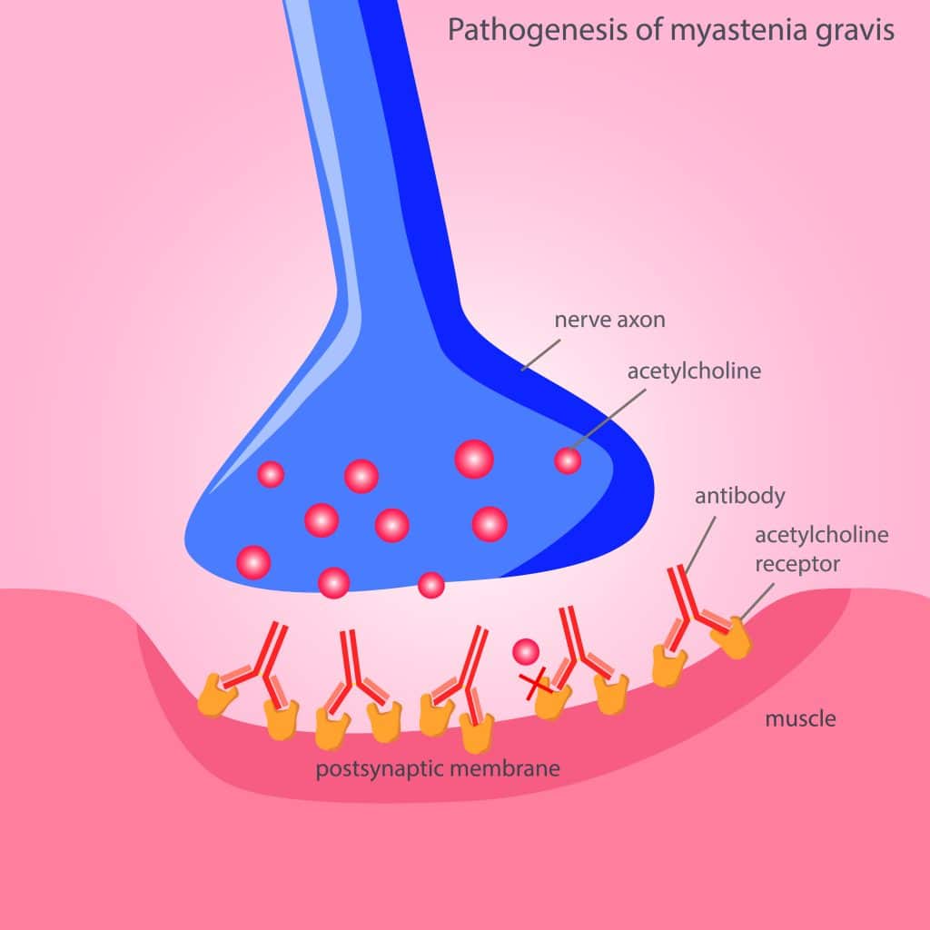 What Causes Myasthenia Gravis - Epigenetics