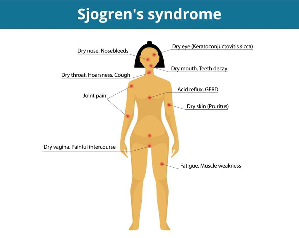 What Causes Sjögren’s Syndrome - And How To Manage It
