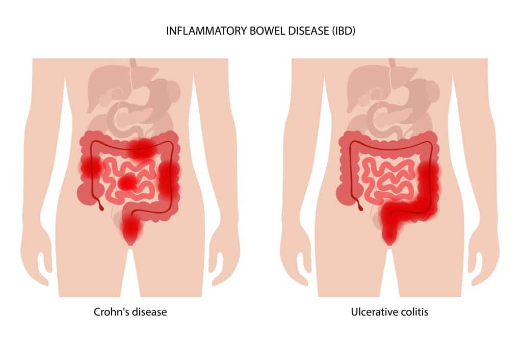 What Causes Crohn’s Disease - Microbiome Dysfunction