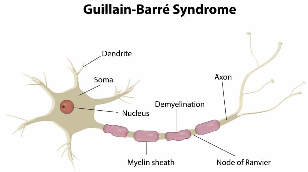 What Causes Guillain-Barre Syndrome - Gangliosides