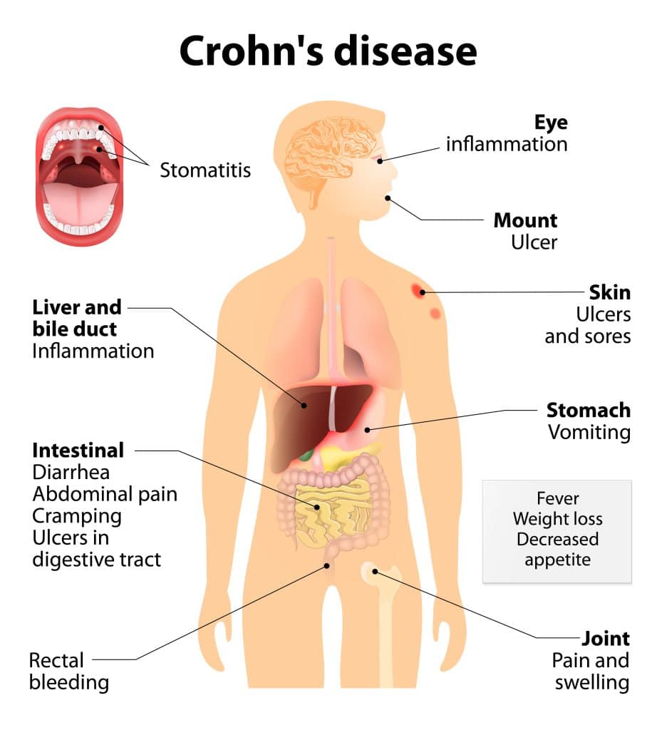 What Causes Crohn’s Disease