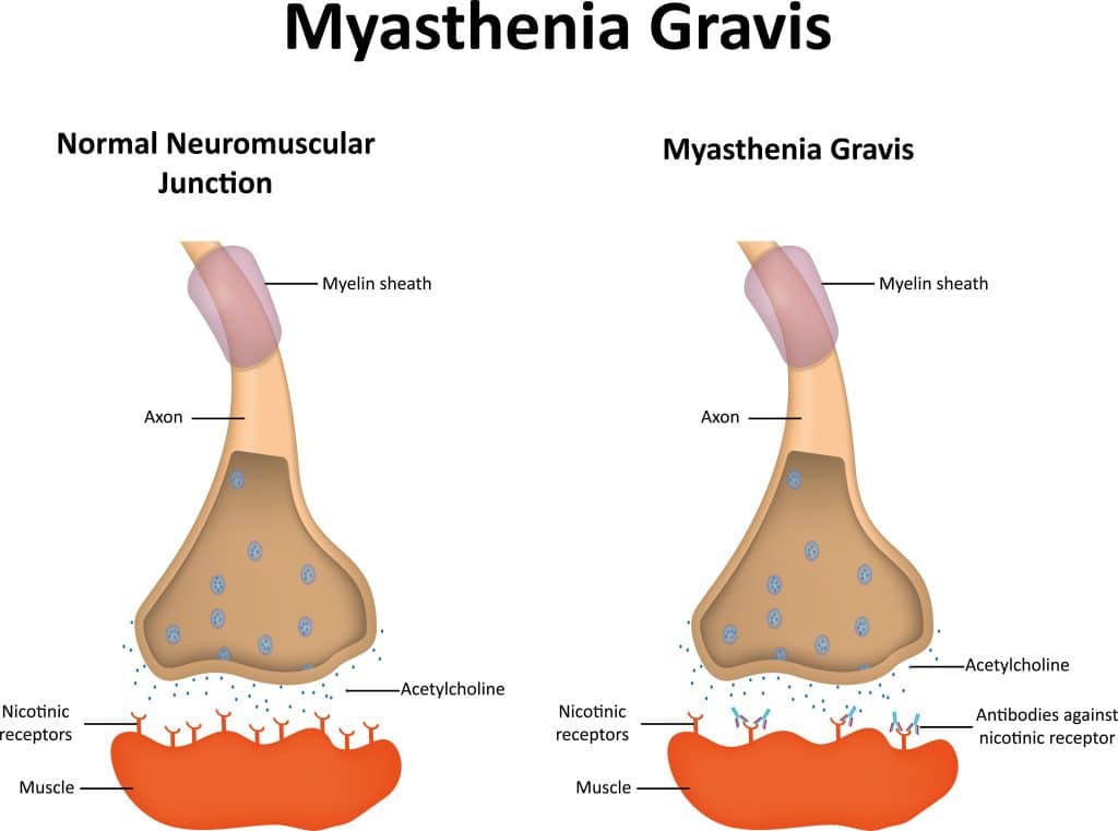 What Causes Myasthenia Gravis