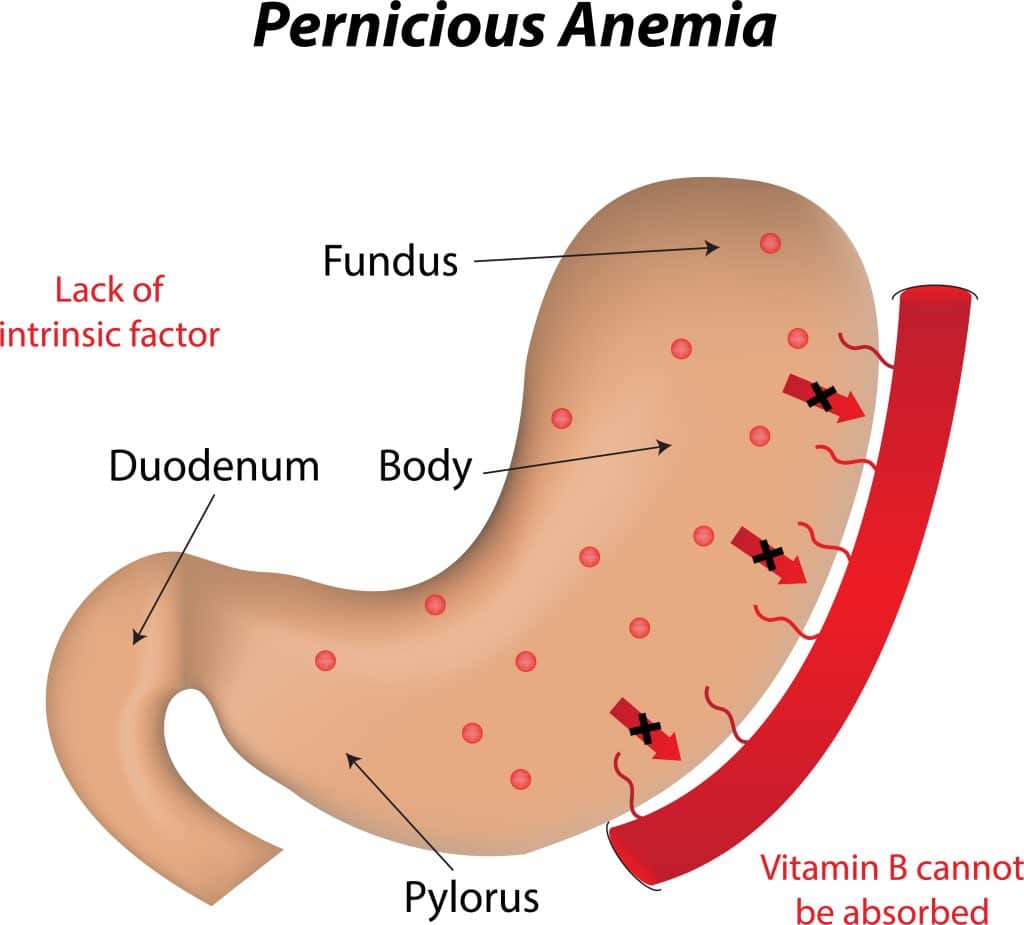 What Causes Pernicious Anemia