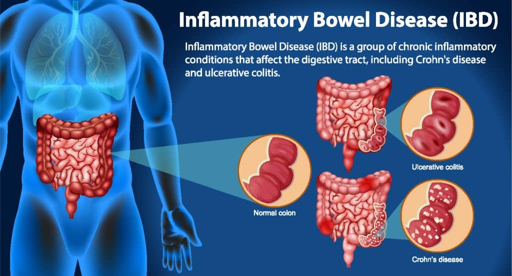 A Look At Autoimmune Diseases - Inflammatory Bowel Disease