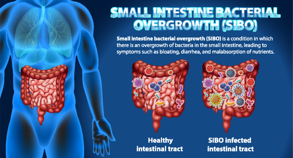 What Causes SIBO