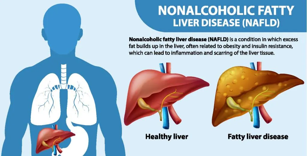 What Causes Fatty Liver Disease | Pompa Program Masterclass